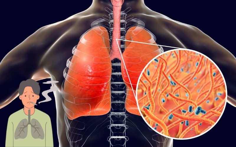 Clear Your Lungs and Stop Coughing in Just Three Days! news